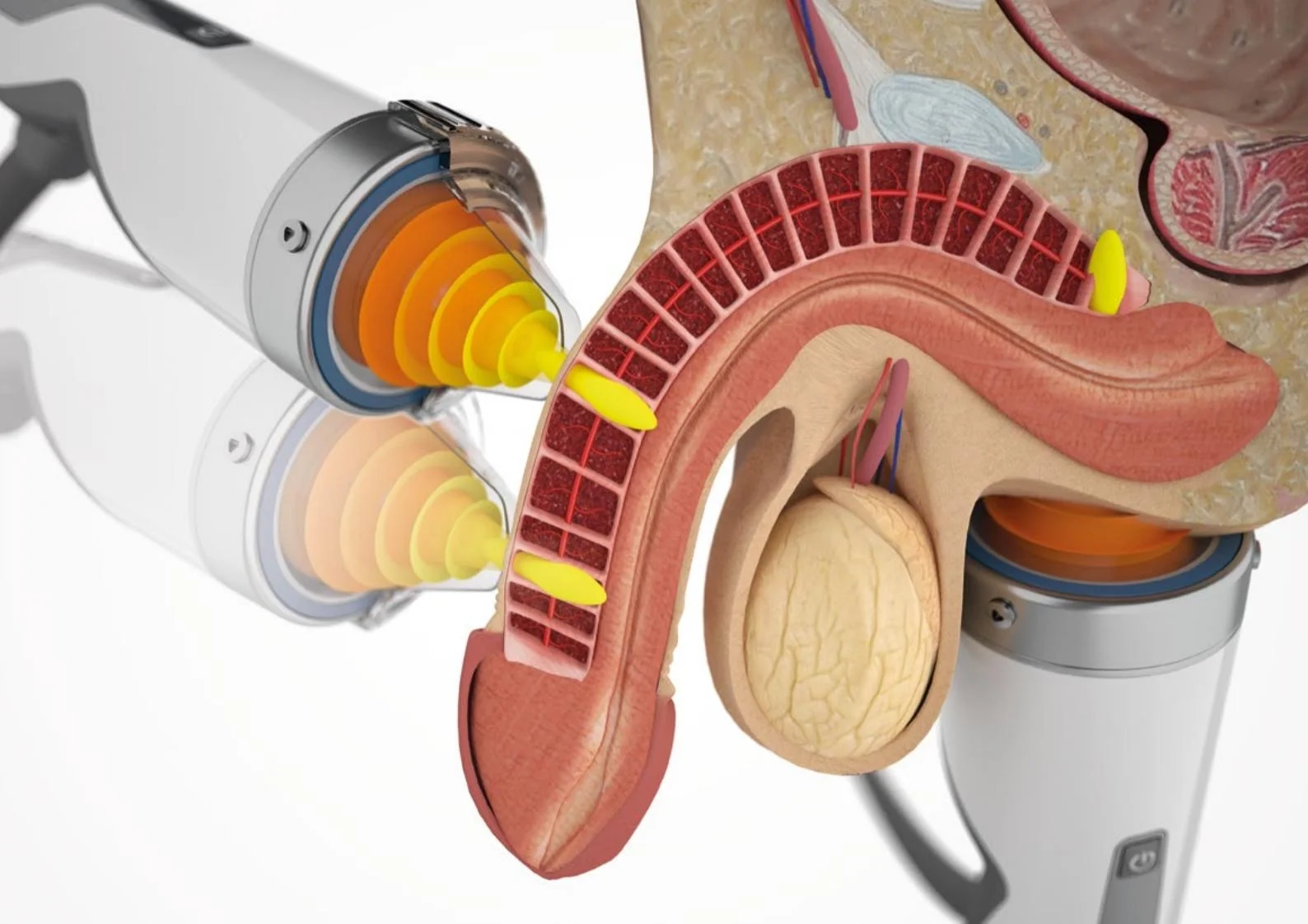 Medische illustratie: focused shockwave (Li-ESWT) richt geluidsgolven gericht op het penisweefsel om de doorbloeding en angiogenese te stimuleren